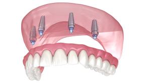 All-On-4 Implant