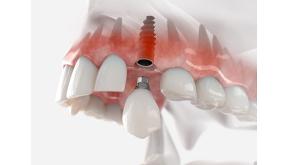 72-Hour Implant and Permanent Teeth