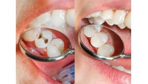 Obturation dentaire